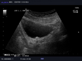 Ultrazvok ledvic - kamen v ostiju levega sečevoda